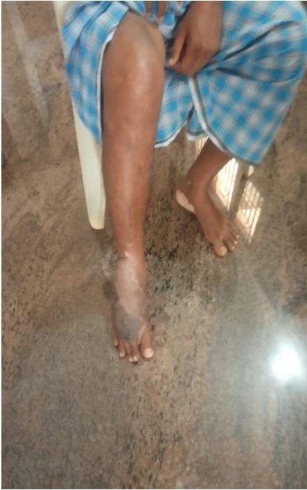 Patient fully recovered