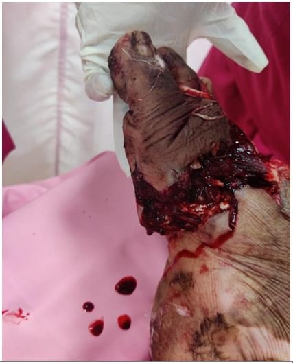 Crush injury right forefoot