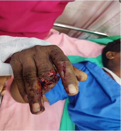 Near-total amputation right hand 3rd finger