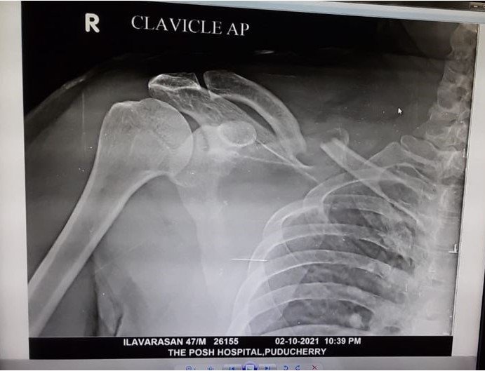 Mid-shaft clavicle fracture